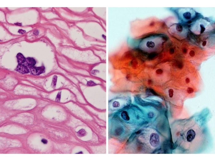 コイロサイトーシス Koilocytosis を再考する　－ なぜ primary HPV testing なのか